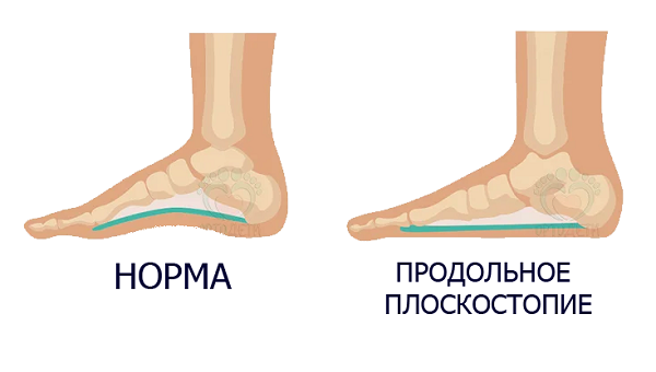 Фото обуви при плоскостопии